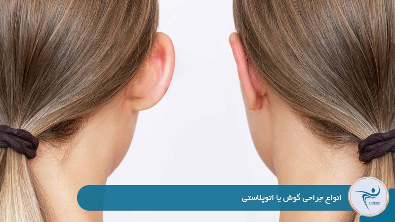انواع جراحی گوش یا اتوپلاستی 
