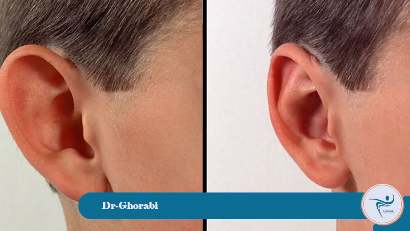 Otoplasty