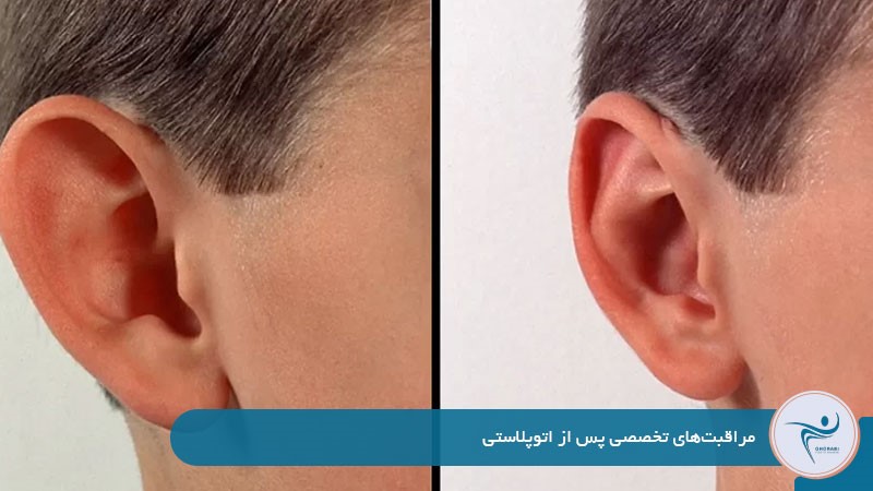 مراقبت‌های تخصصی پس از اتوپلاستی 