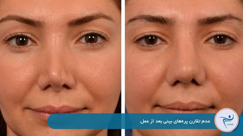 تقارن نداشتن پره‌های بینی بعد از عمل 