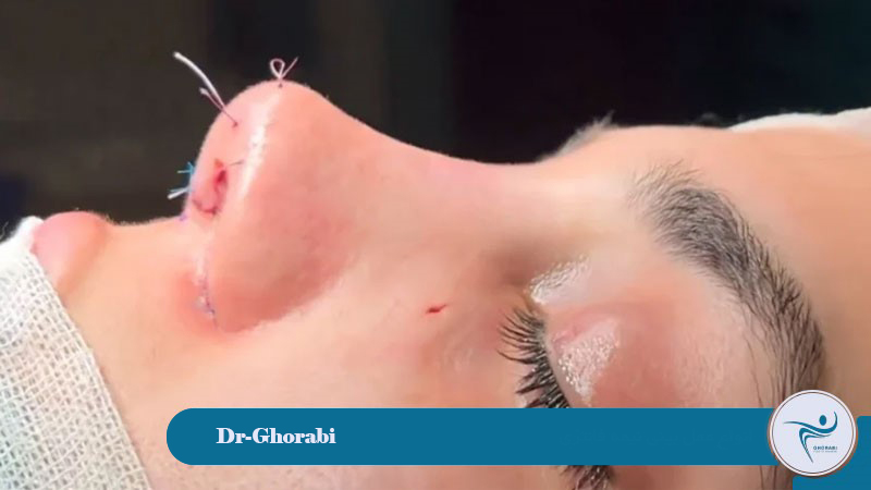 Types of Semi-Fantasy Rhinoplasty 