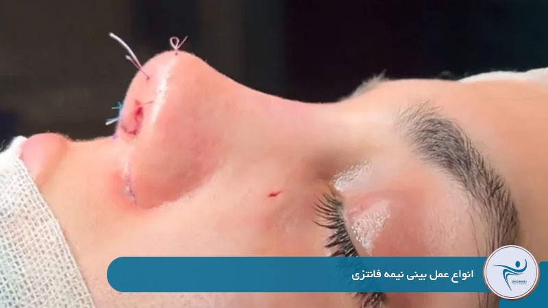 انواع عمل بینی نیمه فانتزی 