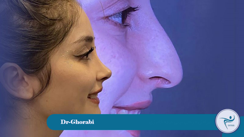Stages of Semi-Fantasy Rhinoplasty Surgery 