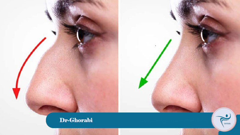 Septorhinoplasty