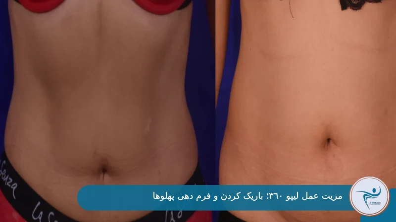 قبل و بعد لیپو 360