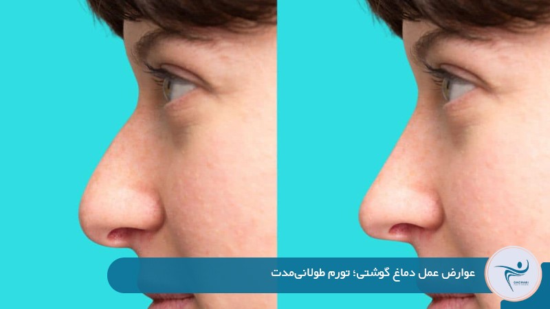 عوارض عمل دماغ گوشتی