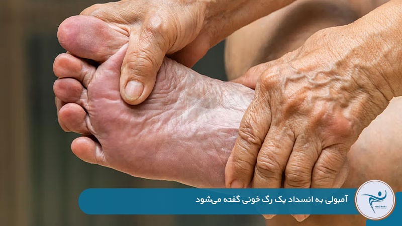علت آمبولی بعد از عمل جراحی