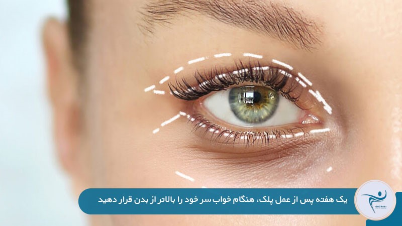 از بین بردن ورم بعد از عمل پلک 