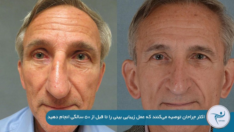 حداکثر سن عمل بینی 