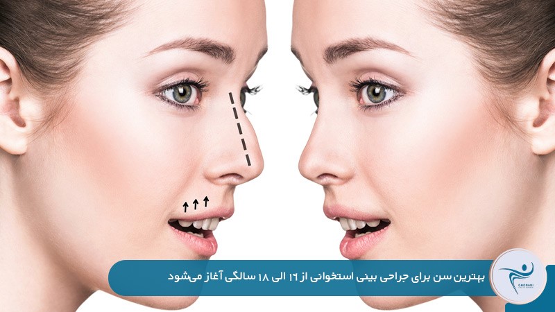 بهترین سن برای عمل بینی استخوانی