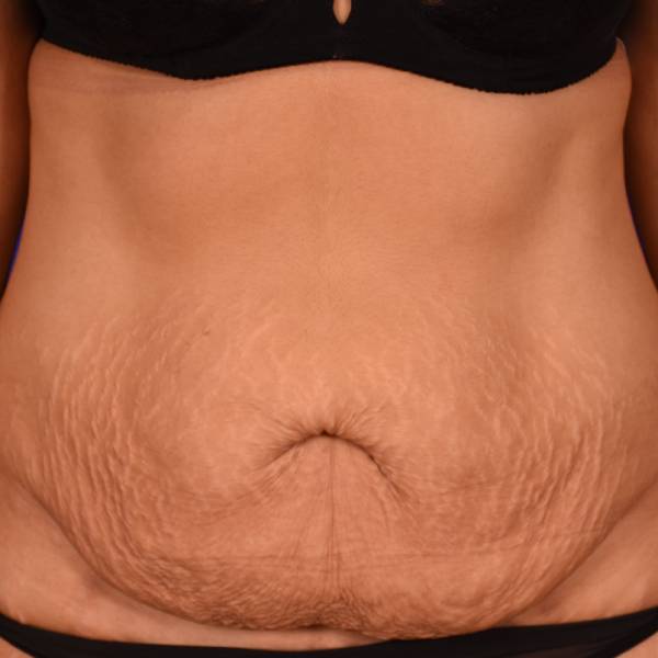 before Image