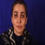 بعد از عمل لیفت اندوسکوپیک ابرو