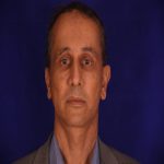 بعد از عمل لیفت کامل صورت