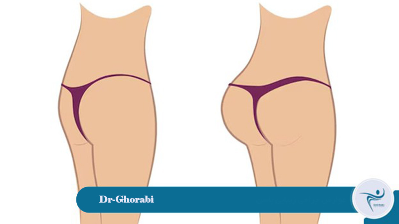 Complications of buttock augmentation surgery 