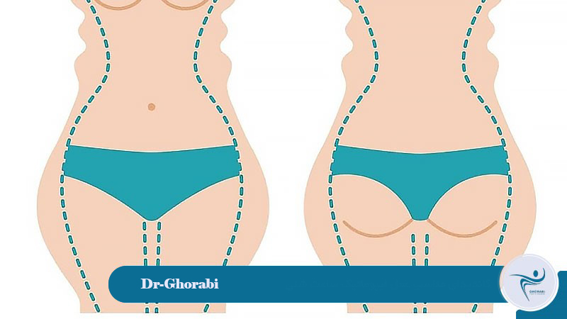 Suitable candidate for hourglass liposuction