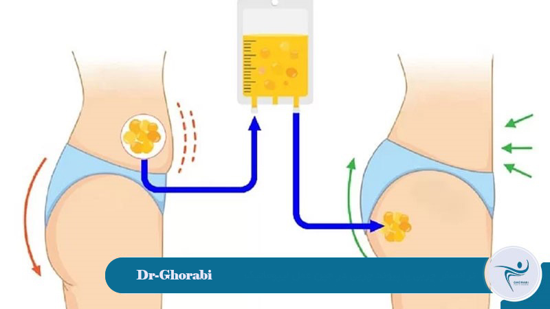 Fat transfer or fat grafting during liposuction. 