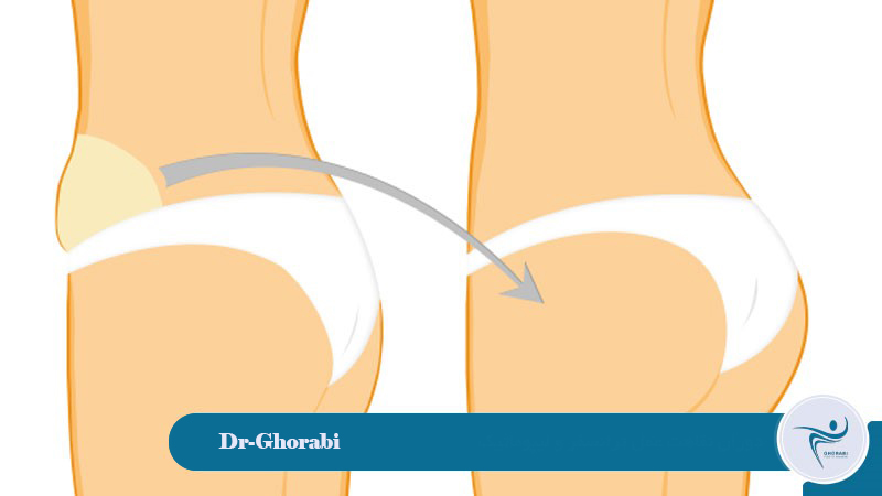 Recovery period for transfer and lipomatic surgery 