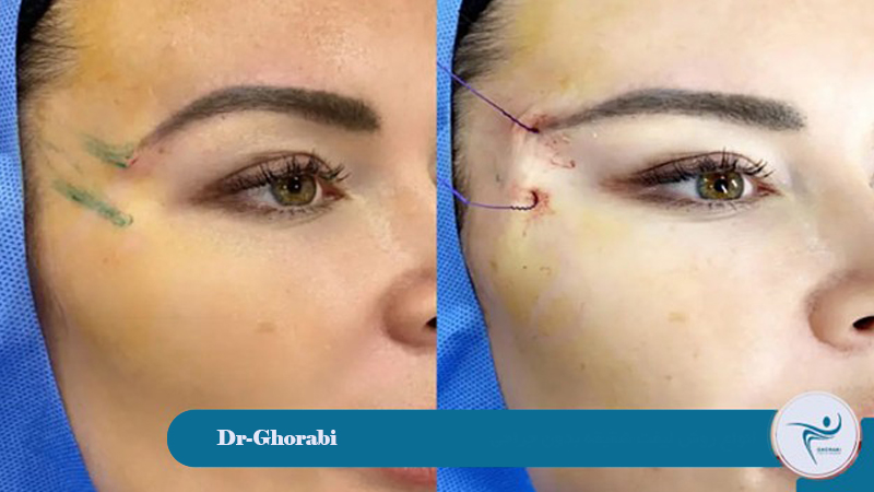 Types of Non-Surgical Temple Lifts 