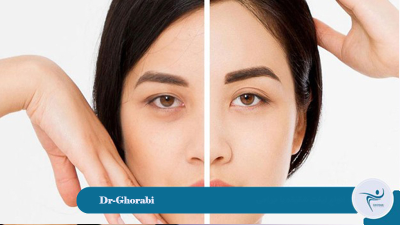 Open Temple Lift (Open brow lift) 