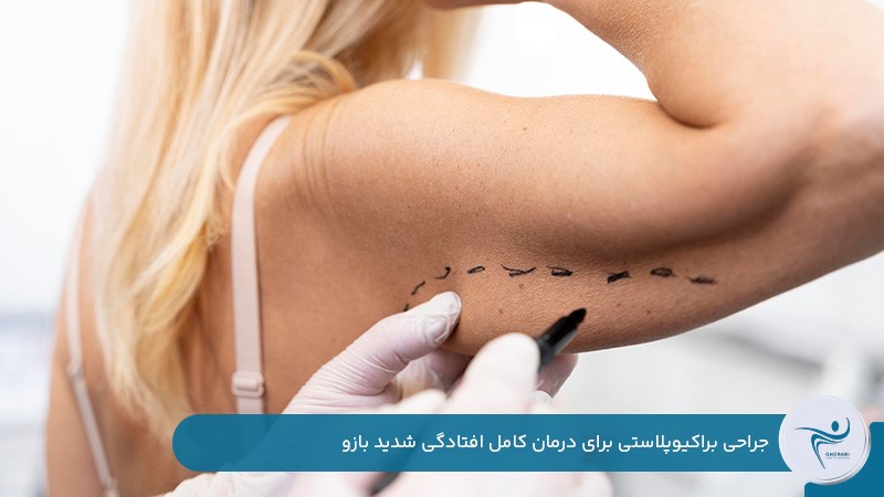 جراحی براکیوپلاستی برای درمان افتادگی بازو