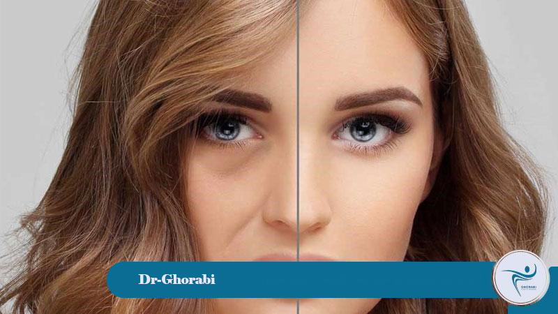 Suitable candidate for mid-face lift surgery 