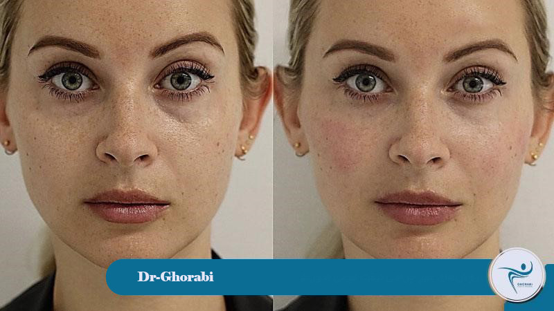 Non-surgical mid-face lift methods 