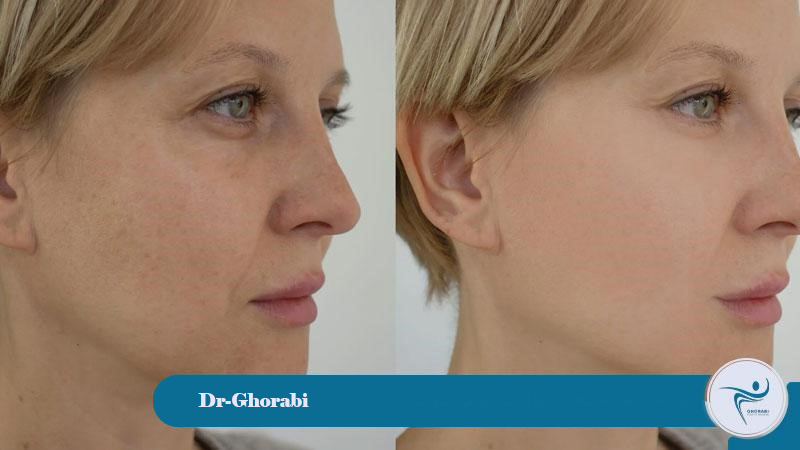 Complications of mid-face lift surgery 