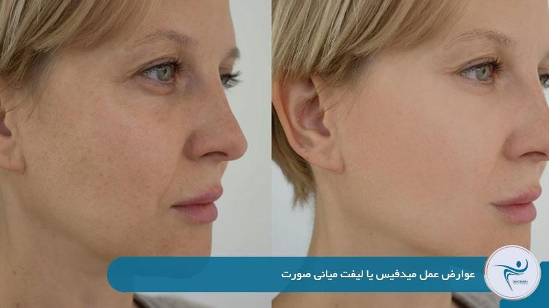 عوارض عمل میدفیس یا لیفت میانی صورت 
