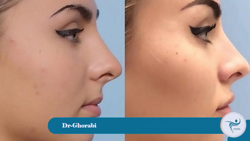 Suitable candidate for cheek implant surgery 