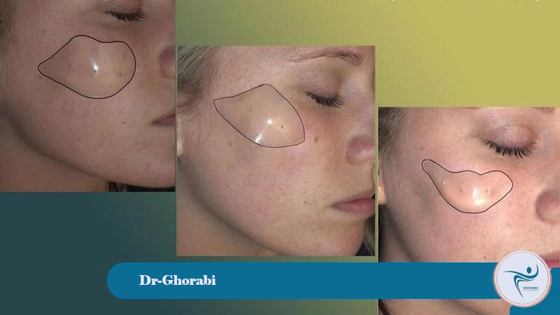 Types of cheek implants based on material and placement 