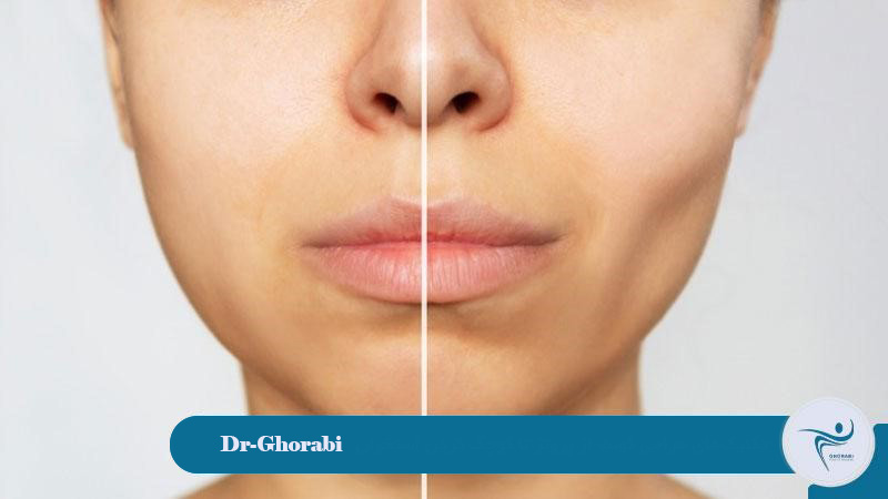 Cheek surgical techniques; from prosthesis to bone reduction. 