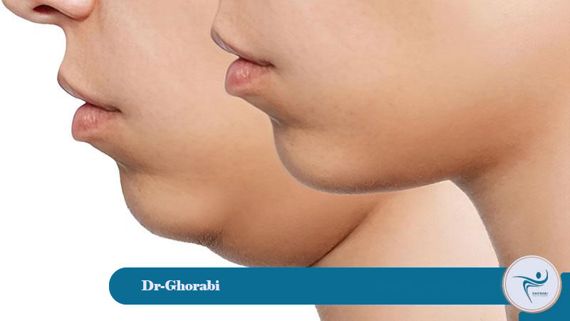 Double chin lift surgery involves: liposuction, neck lift, and submentoplasty. 