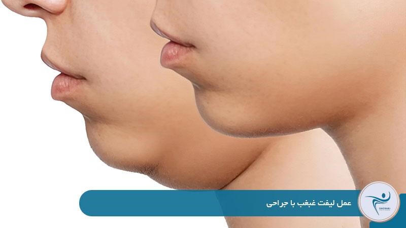 Double chin lift surgery involves: liposuction, neck lift, and submentoplasty. 