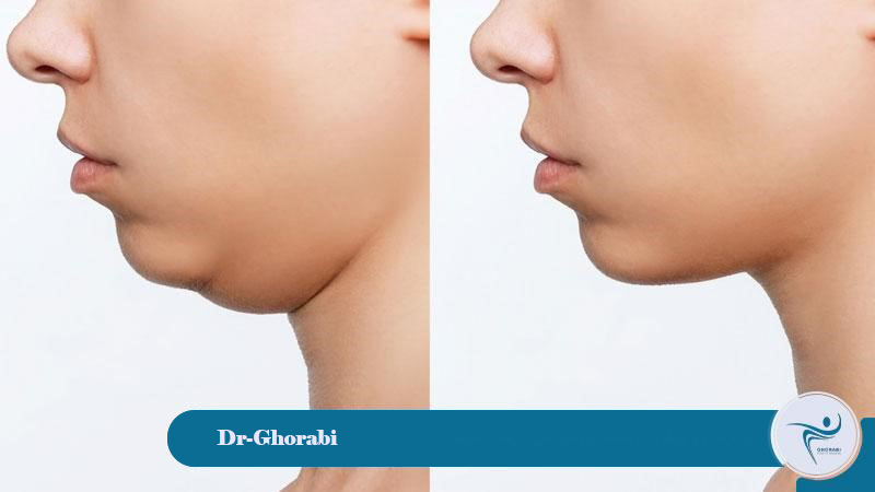 Possible complications and risks of neck lift surgery
