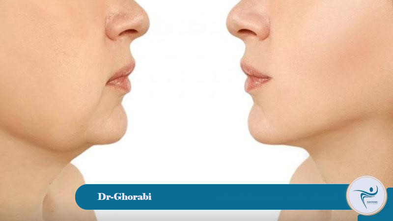 Suitable candidate for chin liposuction 