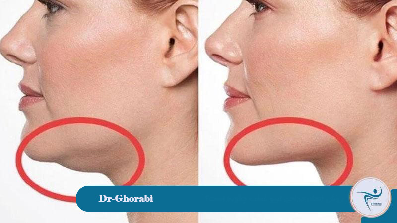 How is chin liposuction performed? 