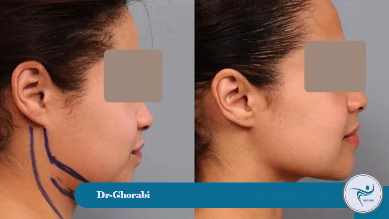 Advantages of double chin liposuction 