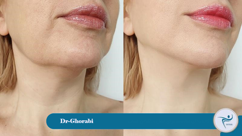 Suitable candidate for double chin suction surgery 
