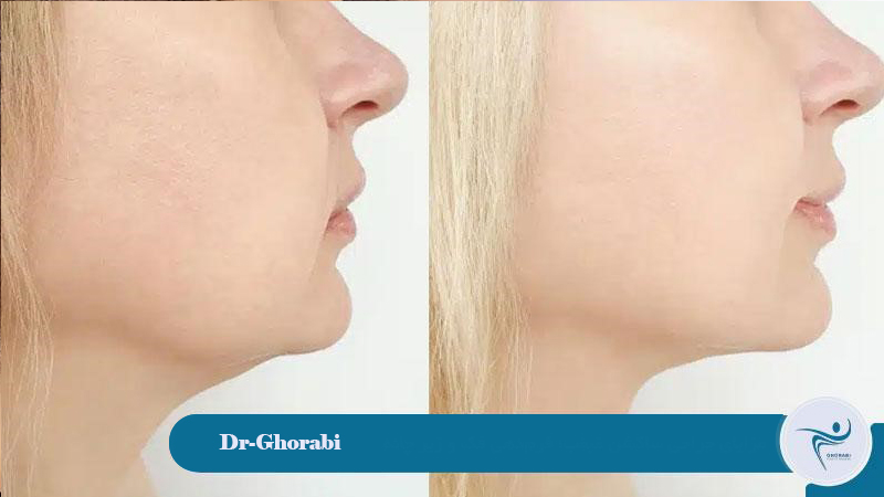 Benefits of chin suction surgery; shaping the jaw and chin 