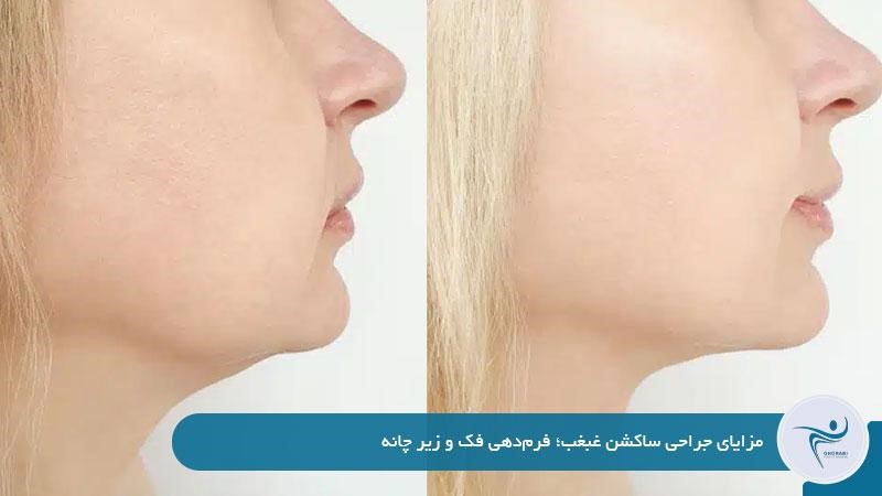 مزایای جراحی ساکشن غبغب؛ فرم‌دهی فک و زیر چانه 