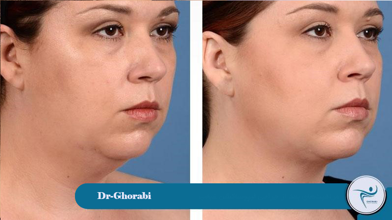 Post-operative care for chin liposuction 