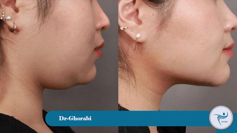 Suitable candidate for double chin removal surgery 