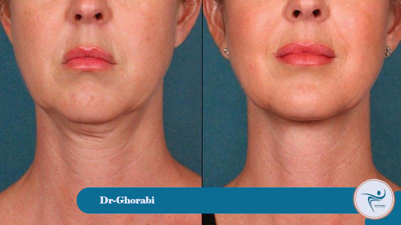 Vaser lipo for double chin; a new and low-risk method 