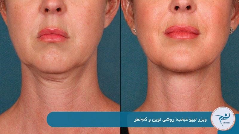 ویزر لیپو غبغب؛ روشی نوین و کم‌خطر 