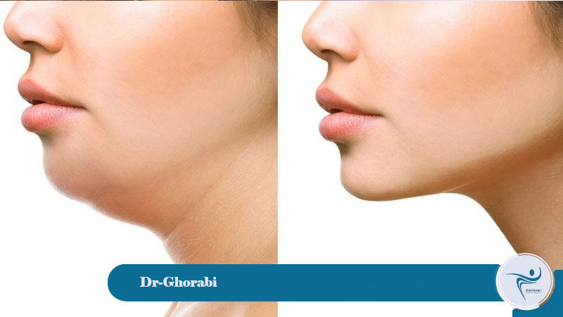 Potential complications and risks of double chin cosmetic surgery 