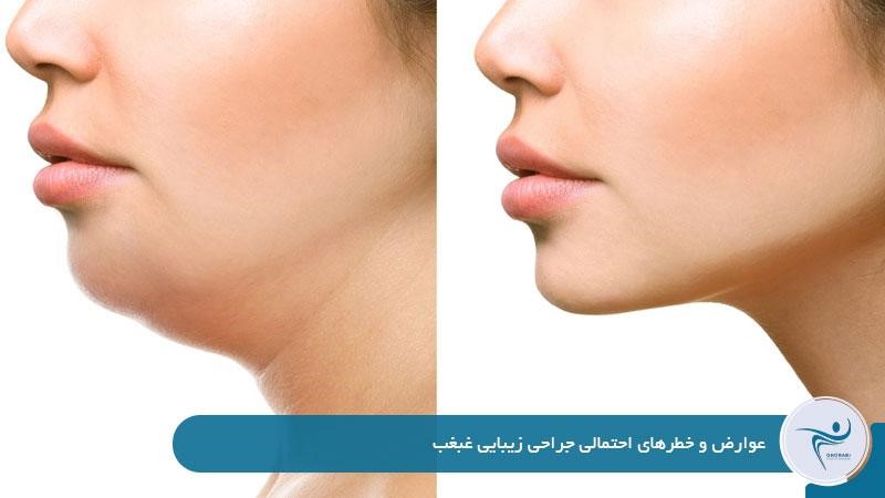 عوارض و خطرهای احتمالی جراحی زیبایی غبغب 