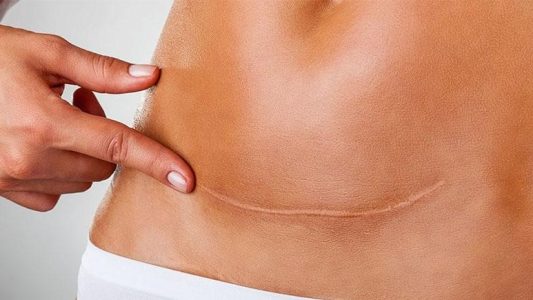 بررسی همه روش‌های از بین بردن خط بخیه ابدومینوپلاستی در مجله دکتر غرابی