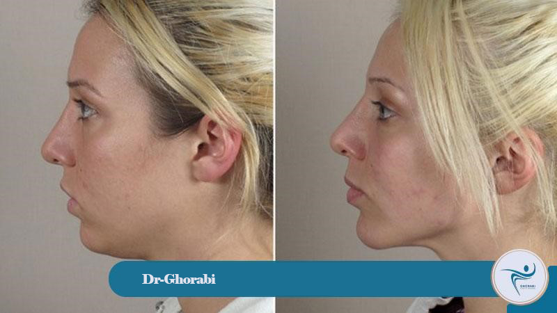 Types of chin injection methods 