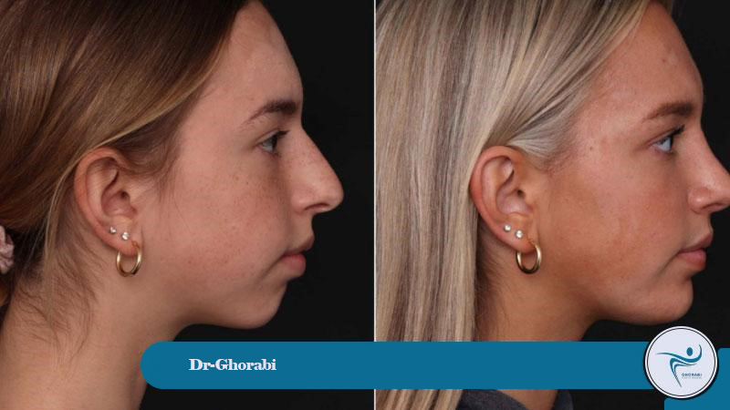 The best candidate for chin injections. 
