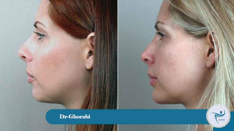 Possible side effects and risks of chin filler injection 